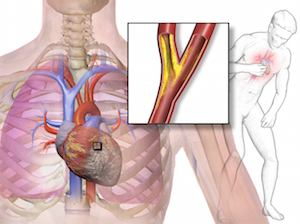 diagrama de angina