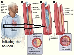 Expansión de una arteria estrecha con angioplastia