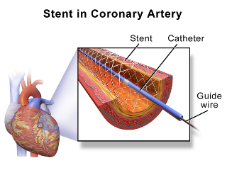 colocación de stent