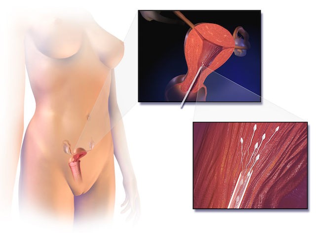 Inseminación intrauterina