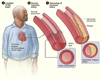 Aterosclerosis de las arterias coronarias