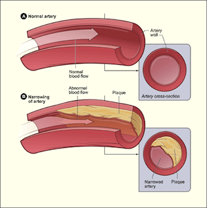 aterosclerosis