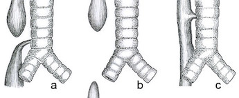 Atresia esofágica, fístula traqueoesofágica