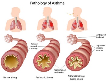 Bronquiolos inflamados: asma