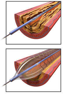 Diagrama de angioplastia con balón