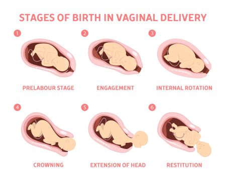 parto vaginal