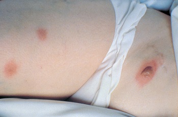 blastomicosis de la piel