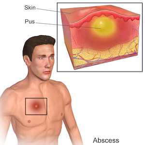 absceso