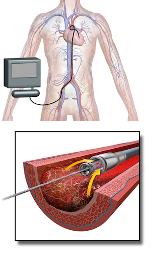 trombólisis intraarterial