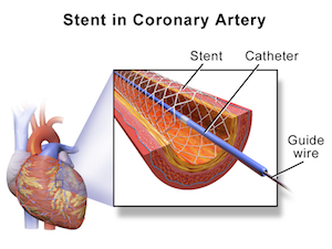 stent