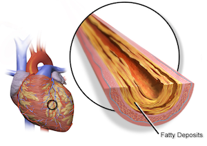 arteriopatía coronaria