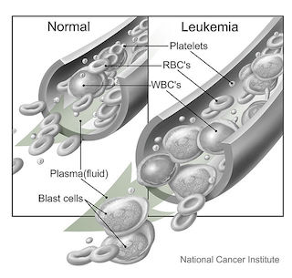 Sangre normal versus leucemia