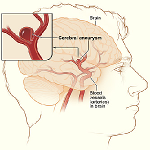 Diagrama de un aneurisma cerebral