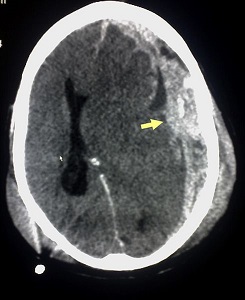 La lesión cerebral puede causar una hernia cerebral