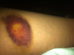Hematoma