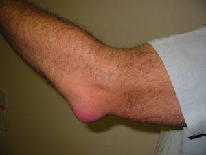 bursitis del olécranon