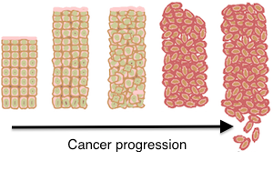 progresión del cáncer