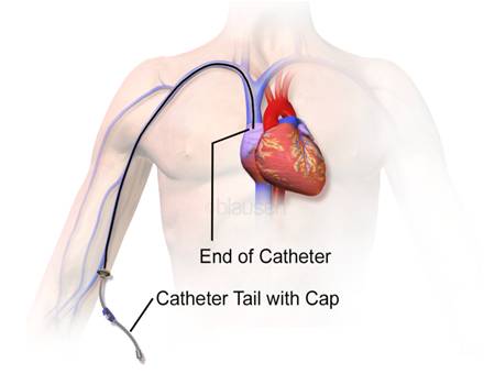 catéter