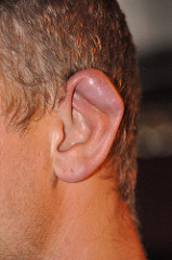 Ejemplo de oreja de coliflor