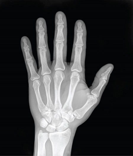 Radiografía de la mano