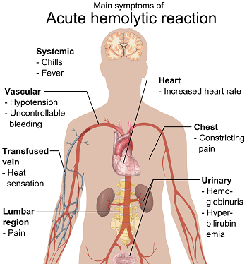 anemia hemolítica aguda