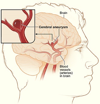 Aneurisma Cerebral