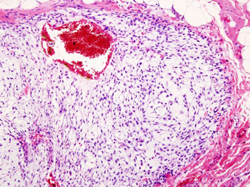 condrosarcoma