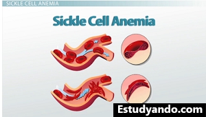 Anemia falciforme