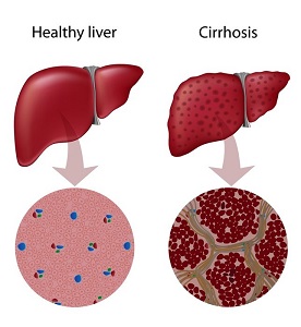 cirrosis
