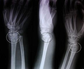 Radiografía de fracturas de Colles