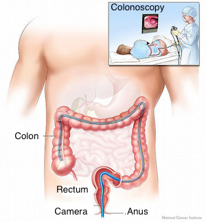 colonoscopia