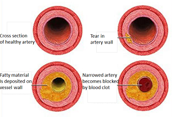 arteriopatía coronaria