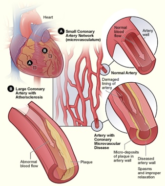 arterias coronarias