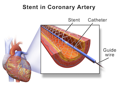 stent coronario