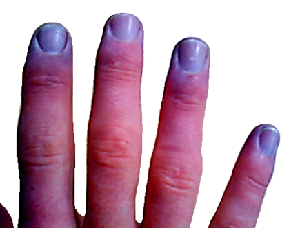 Cianosis