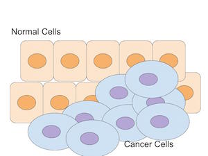 Células cancerígenas