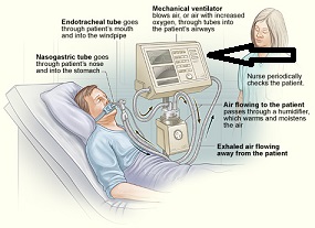 Ventilador para ayudar con la respiración