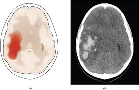 cerebro