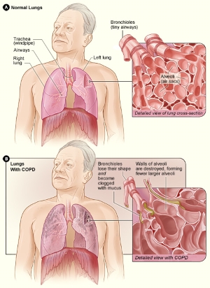 cambios en la estructura de la copd