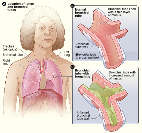 Bronquitis: hinchazón y moco en los bronquiolos de los pulmones.