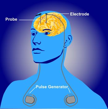 estimulación cerebral profunda 
