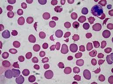 CID con anemia hemolítica microangiopática