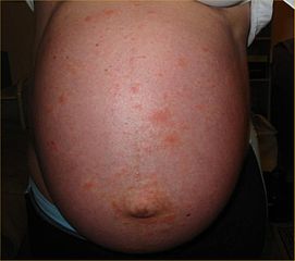 Inflamación abdominal severa, también conocida como distensión.