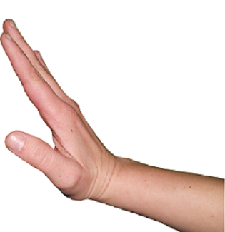 mano de dorsiflexión