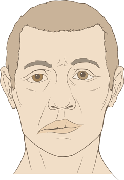 cara caída