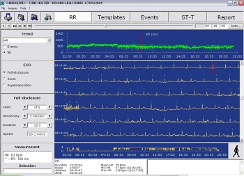 ECG_monitor