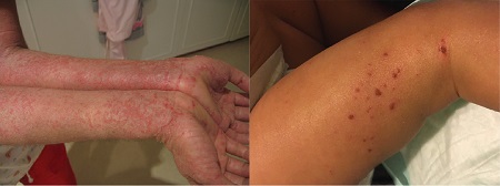 Imágenes de eczema