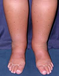 edema