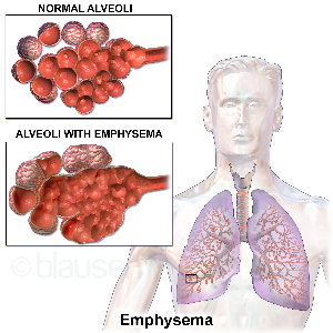 Diagrama de enfisema