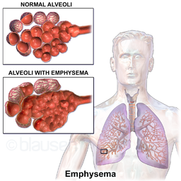 Enfisema 2
